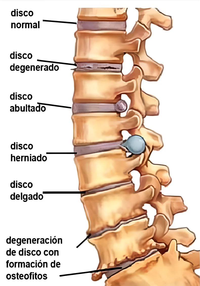 Tratamiento no quirúrgico para hernia de disco sin cirugía con medicamentos homeopatizados y ozonoterapia